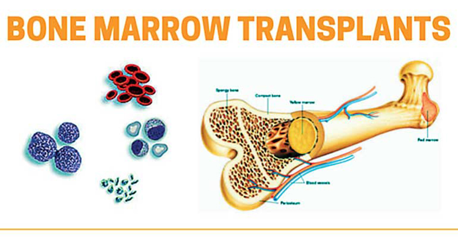 Bone Marrow Transplant